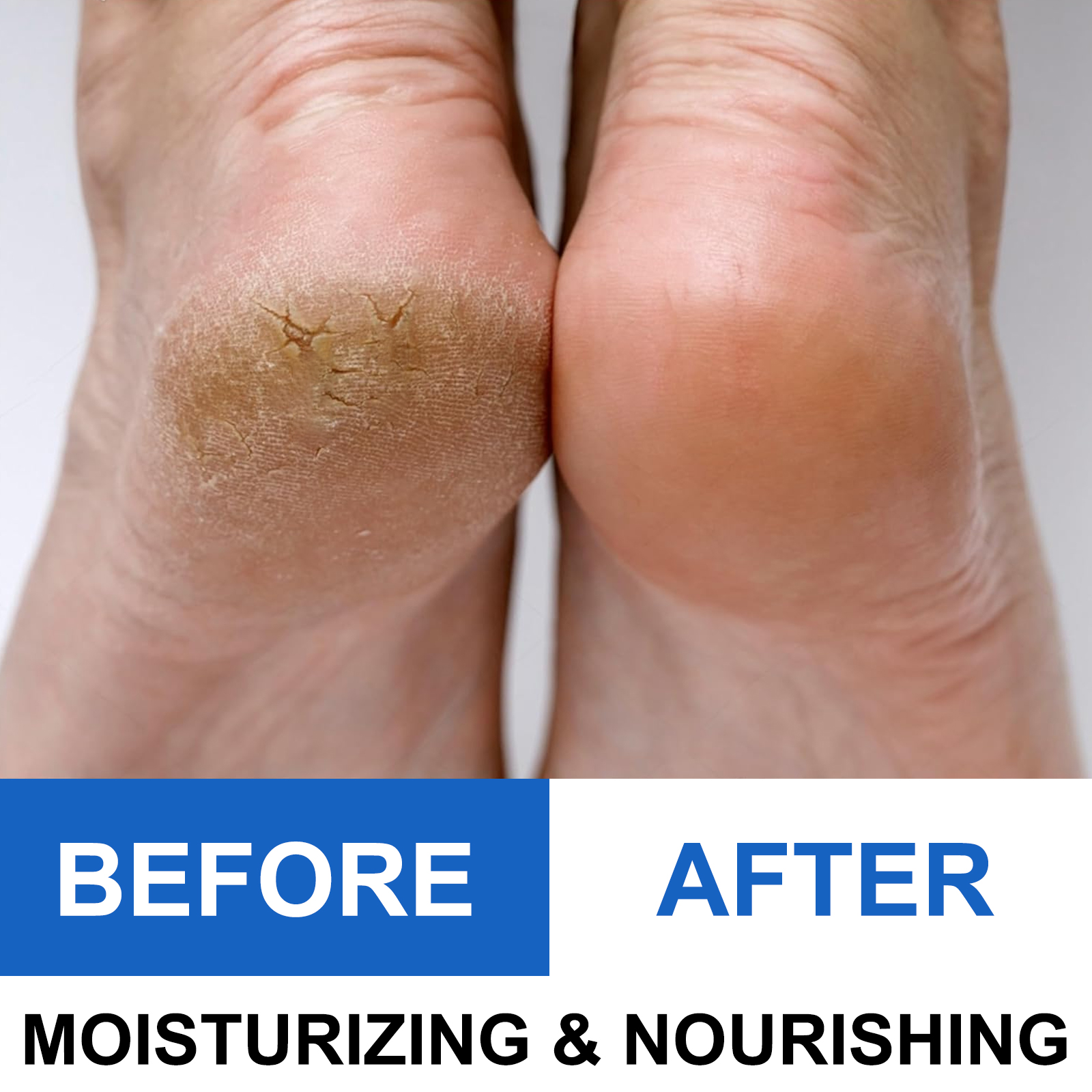40% Urea Foot Cream Stick - Mo - огляд і ціна Azelaic Acid Cream